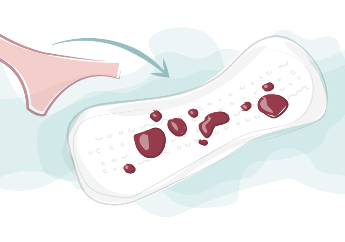 Last van klonten en stolsels bij de menstruatie?