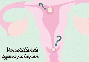 Welke typen poliepen zijn er?