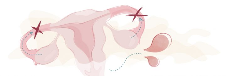 Heeft sterilisatie invloed op je menstruatie?