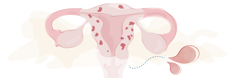 10 Vragen over… adenomyose