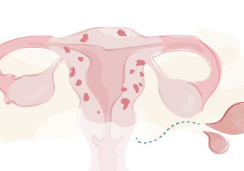 10 Vragen over… adenomyose